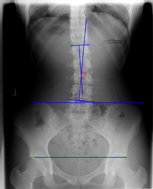Scoliosis