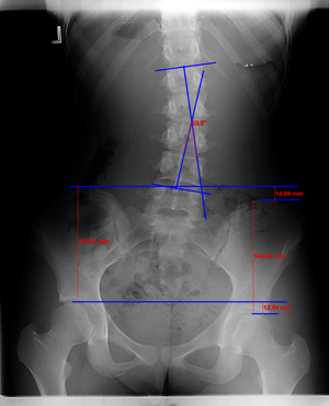 Scoliosis